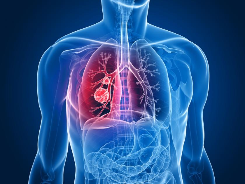 Chronic Obstructive Pulmonary Disease