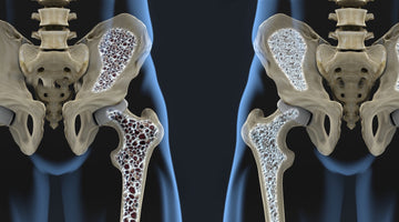 Risk Factors For Osteoporosis