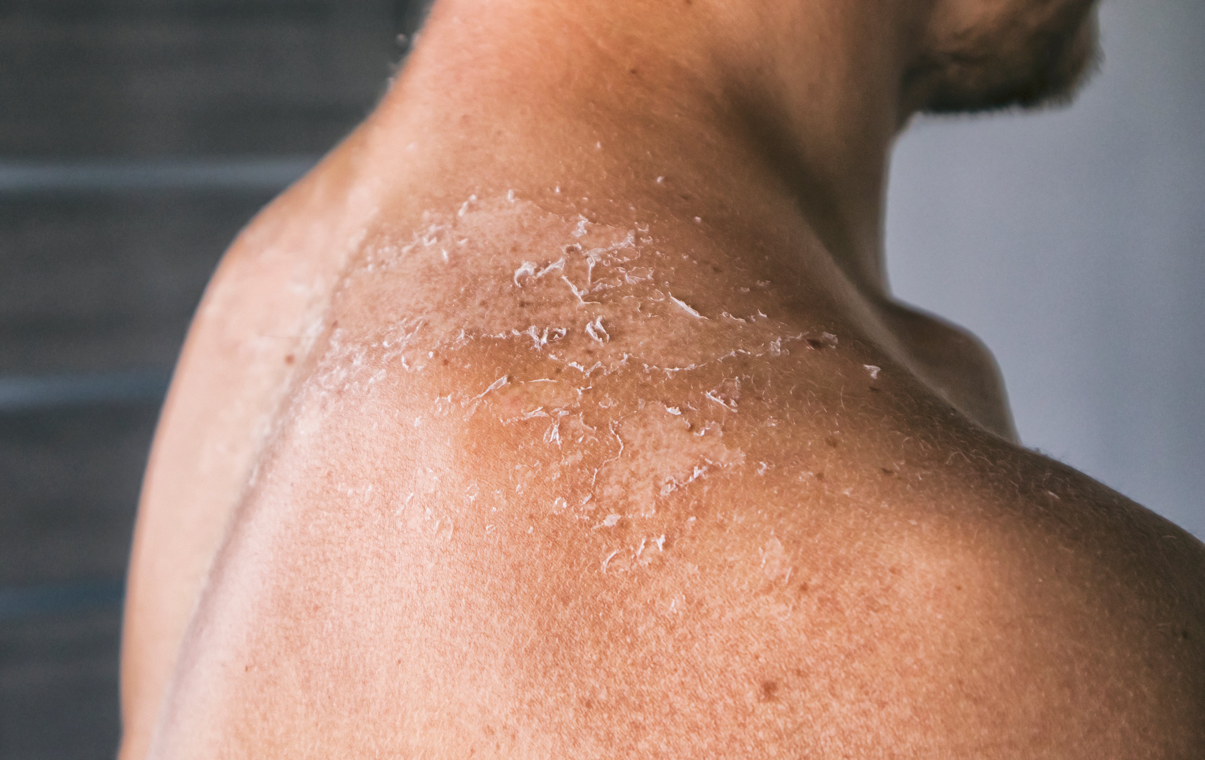 Dry skin